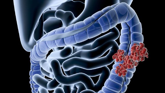Studi Temukan Vitamin Ini Membantu Mengurangi Risiko Kanker Usus Besar